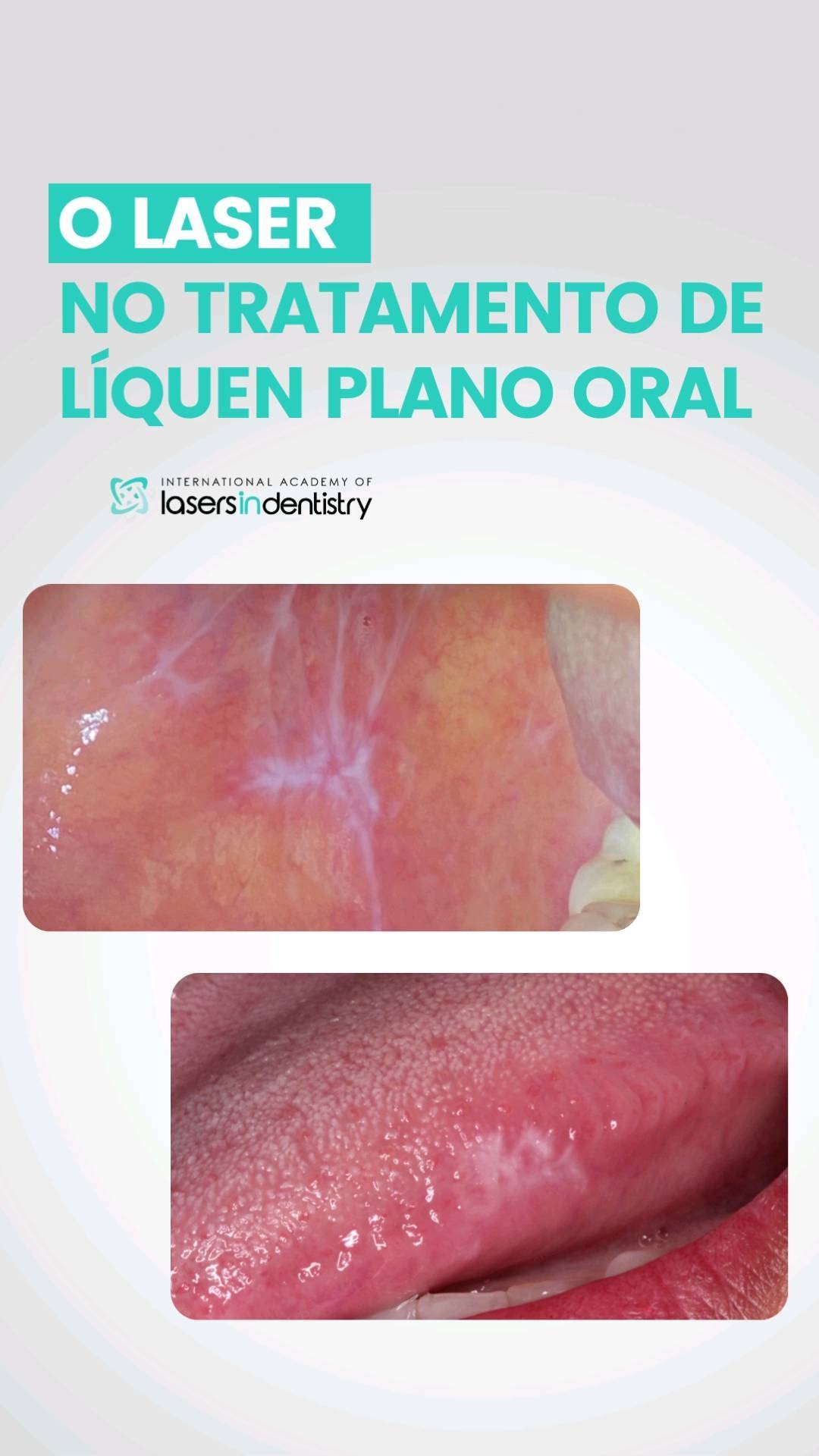 Líquen plano oral tratado com laser
