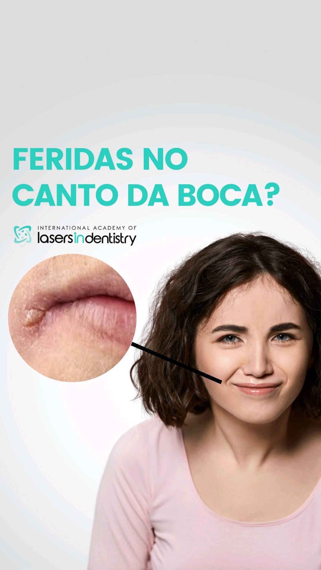 Feridas no canto da boca: causas e tratamento com laser